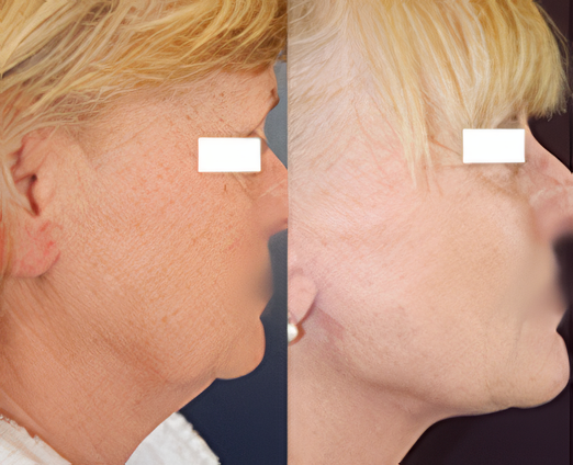Facelift