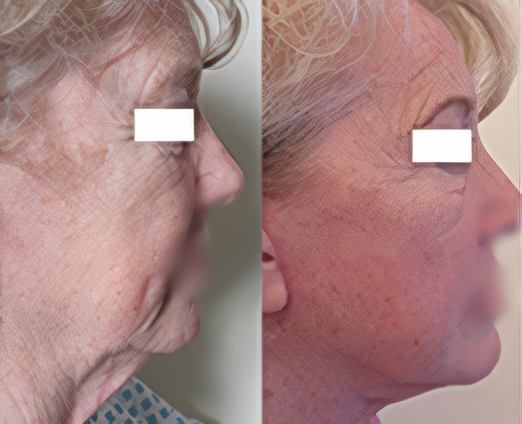 Facelift
