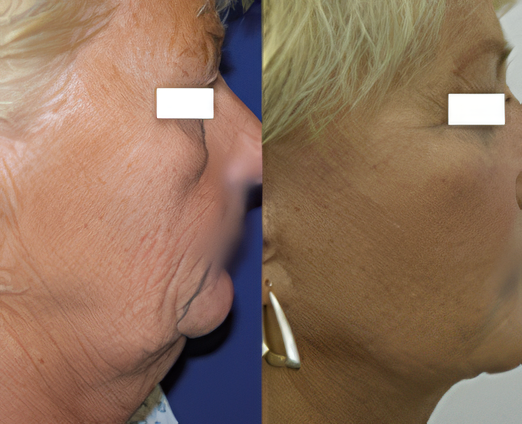 Facelift