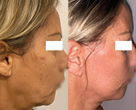 Facelift