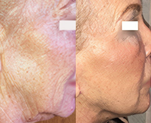 Facelift