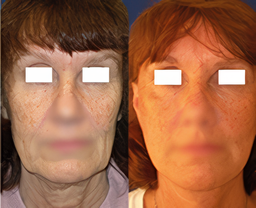 Facelift