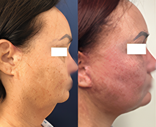 Facelift