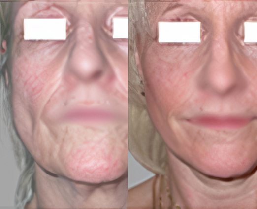 Facelift
